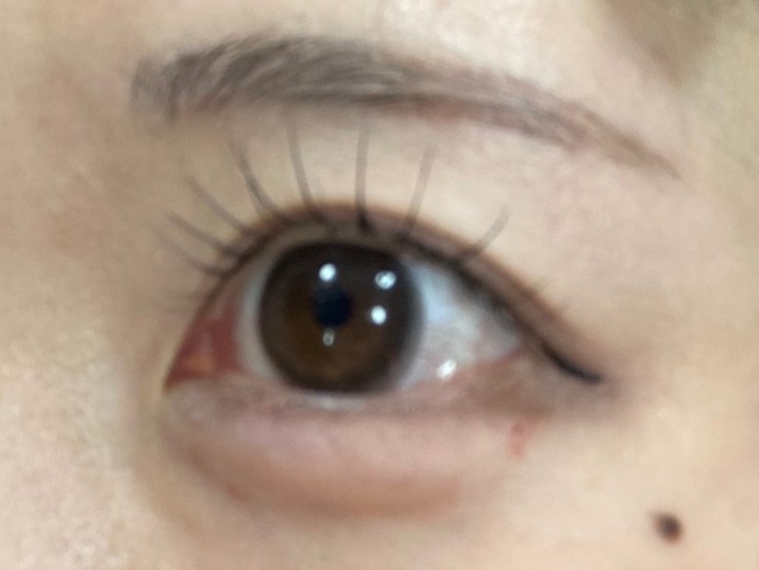 after photo: 涙袋ヒアルロン酸