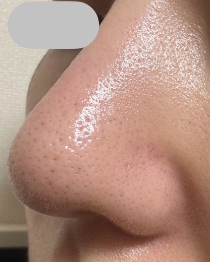 after photo: ハイドラジェントル