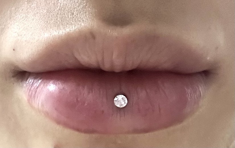 before photo: 필러제거주사