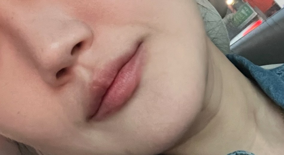 before photo: 입꼬리필러