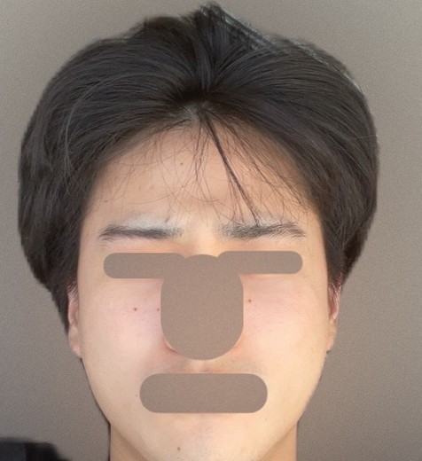 after photo: ダーマペン