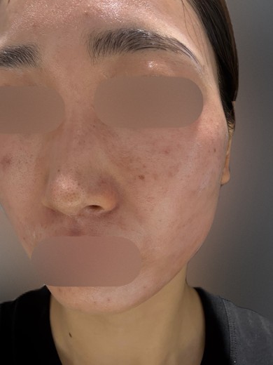 after photo: ハイドラフェイシャル, 診断・検査