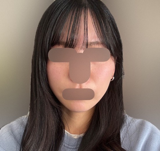after photo: 糸リフト