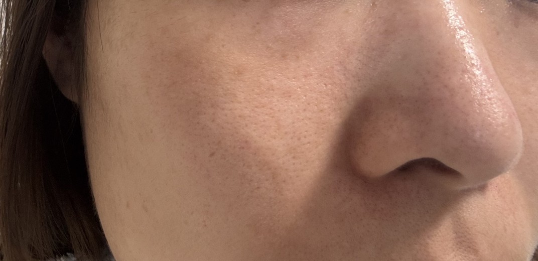 after photo: ダーマペン