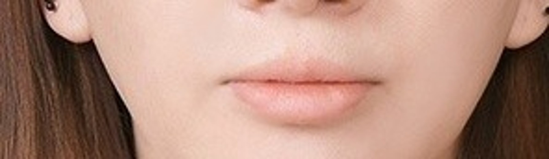 before photo: 입술축소술