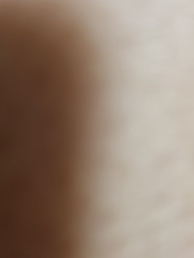 before photo: 이마필러