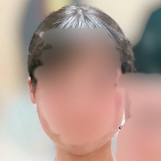 after photo: 脂肪溶解注射(顔)