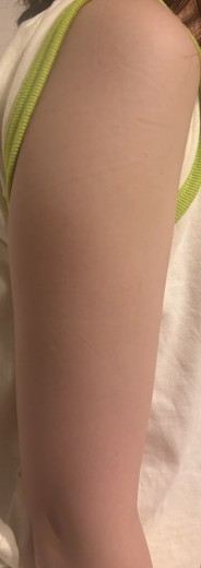 before photo: 脂肪冷却(腕)