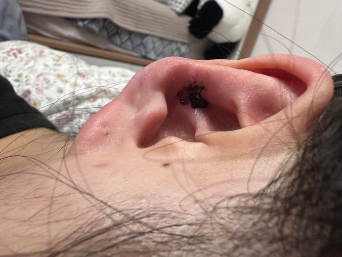 after photo: 캘로이드귀성형