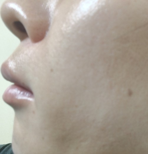 after photo: ポテンツァ(POTENZA), 診断・検査, ジュベルック(Juvelook)