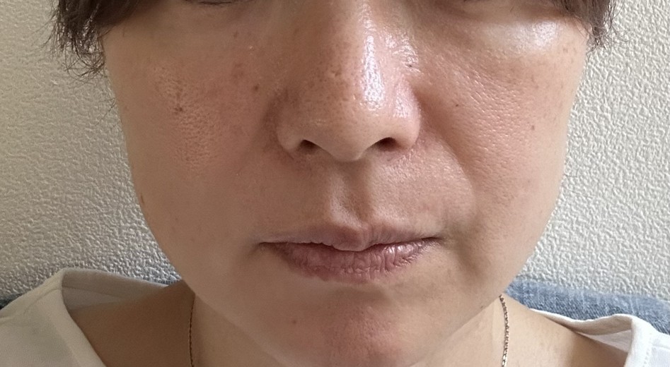before photo: ダーマペン