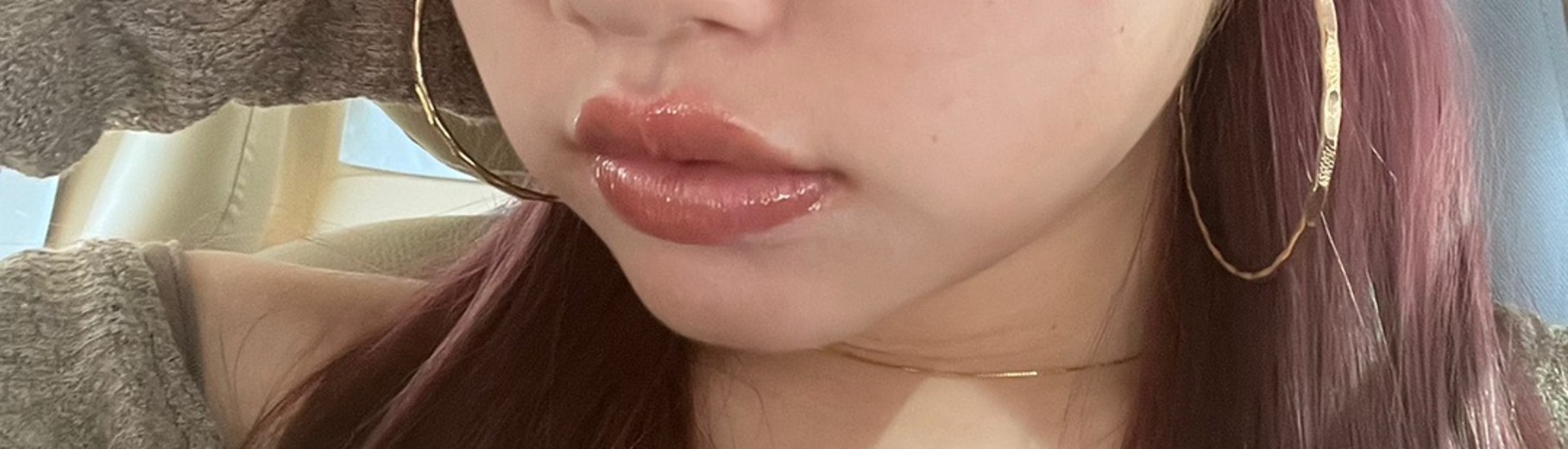 after photo: ふくらはぎボトックス, エラボトックス