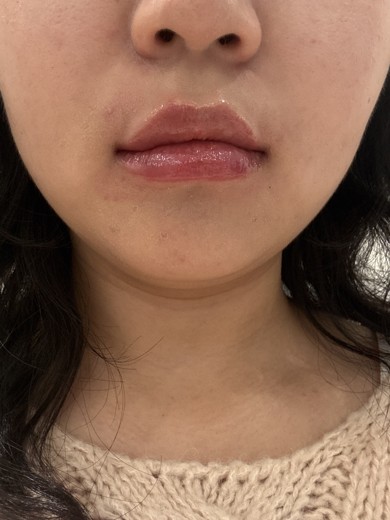 after photo: 입꼬리필러, 입술필러