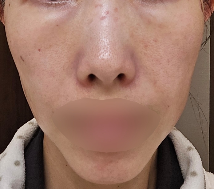 2023年最新エレクトロポレーション ハイドラフェイシャル 2023年最新