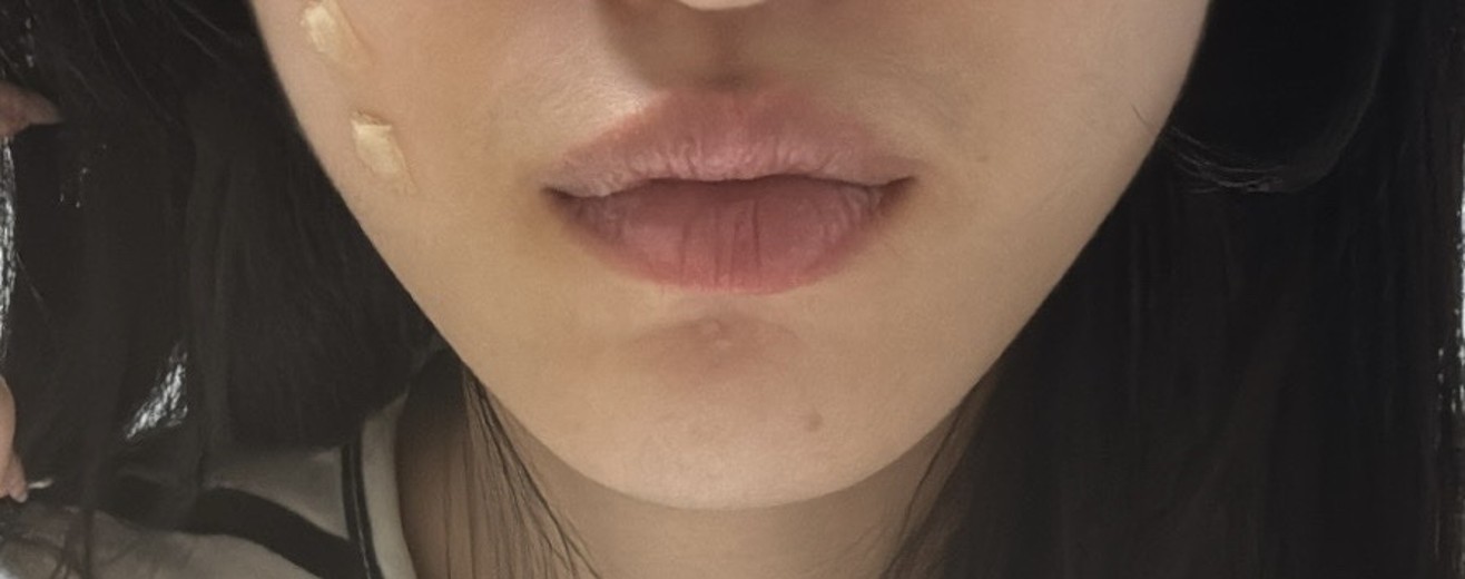 after photo: 사각턱보톡스, 슈링크유니버스