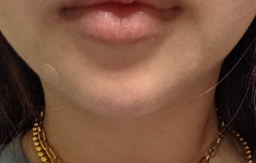 after photo: 입술필러