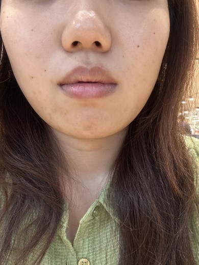 before photo: イオン導入