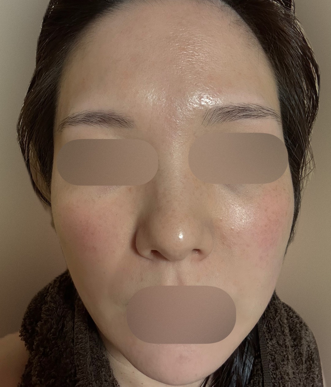 エレクトロポレーション＋ピーリング | フォンタナクリニック天神