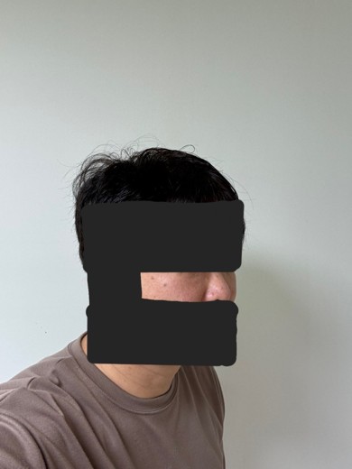 after photo: 눈밑지방재배치