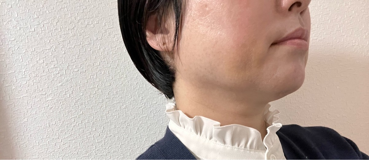 after photo: 脂肪溶解注射(太もも)