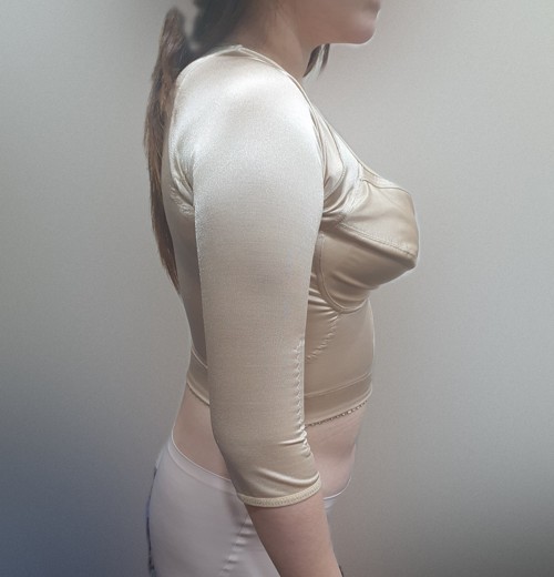 after photo: 팔지방흡입