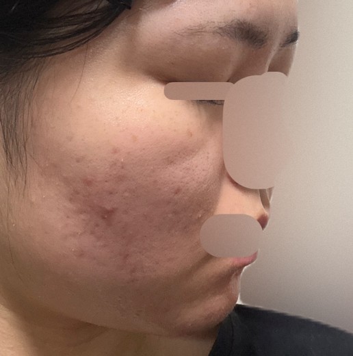 after photo: IPL(光/フォト治療)