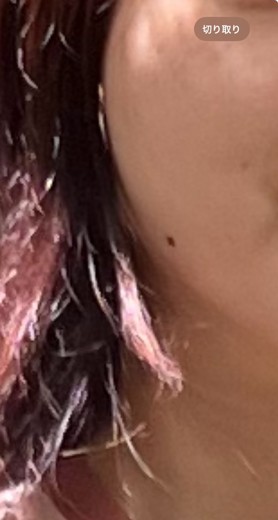 before photo: ダーマペン
