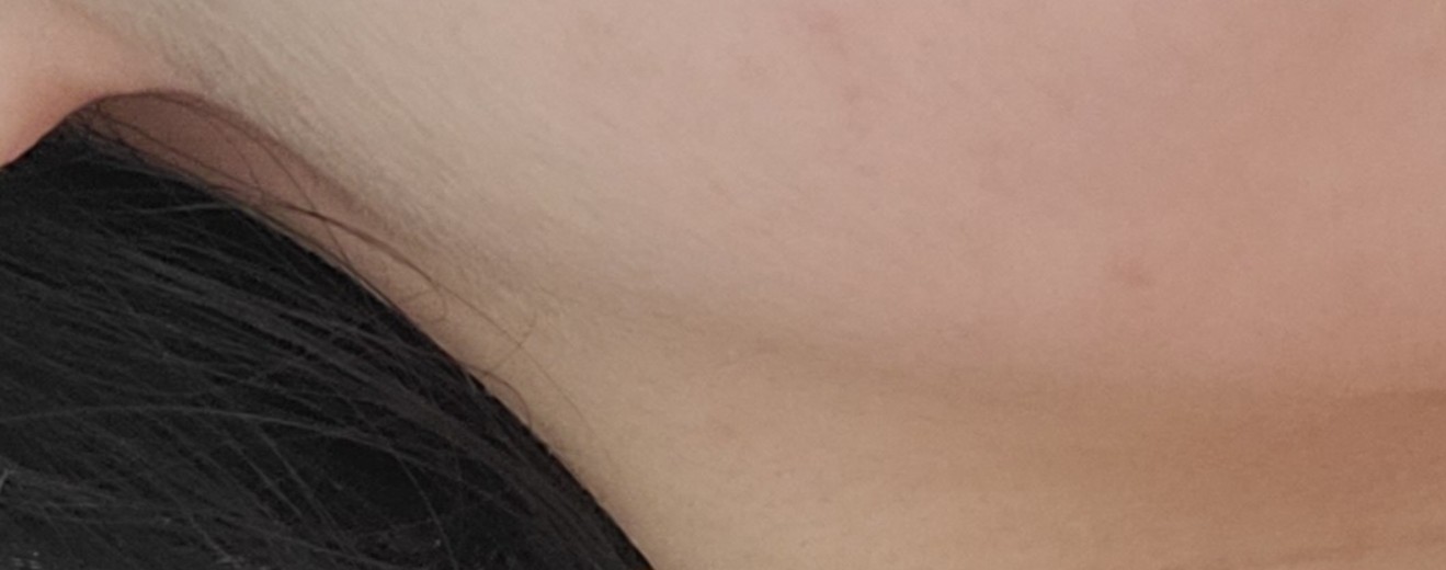 after photo: 윤곽주사