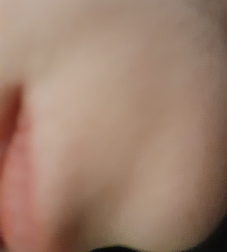 after photo: 여드름주사