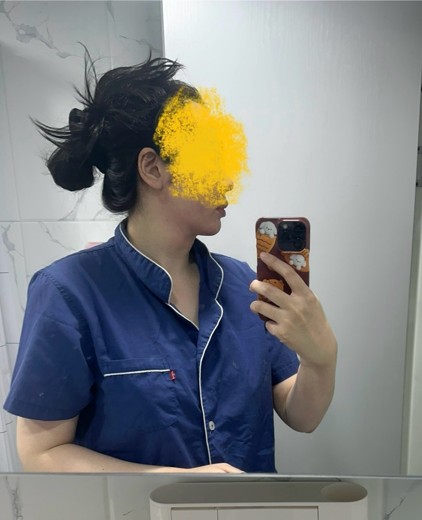 after photo: 이중턱지방흡입, 얼굴지방흡입