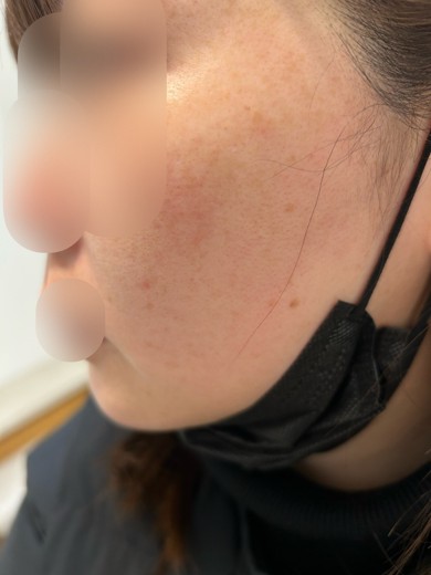 before photo: ピーリング