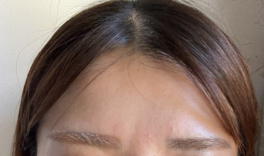 after photo: 眉間ボトックス