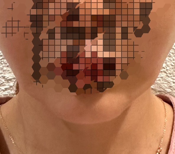 after photo: 糸リフト