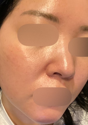 before photo: ルメッカ