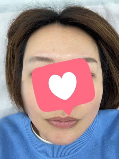 before photo: 眉間ボトックス, 脇ボトックス, エラボトックス