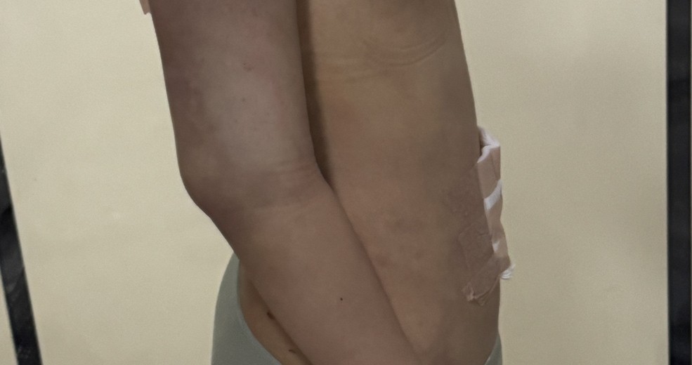 after photo: 복부지방흡입