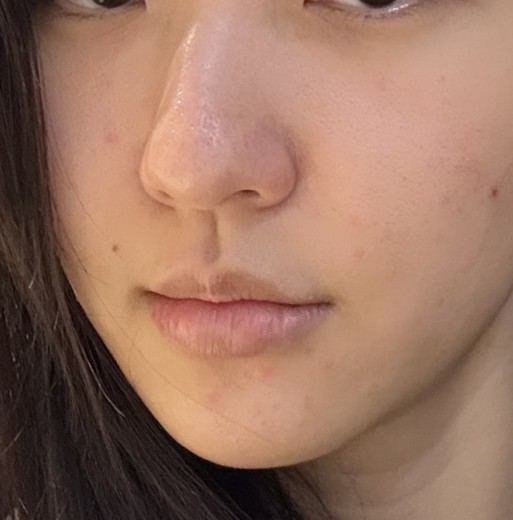 before photo: ダーマペン