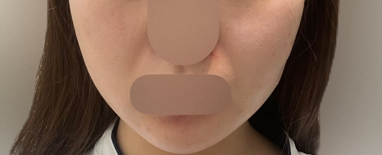 after photo: 脂肪溶解注射(顔)