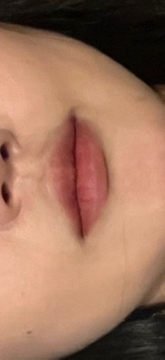 after photo: 입꼬리필러