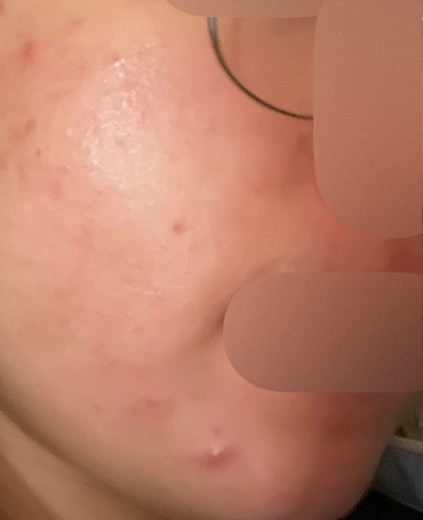 before photo: 여드름주사