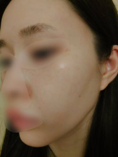 after photo: IPL(光/フォト治療)