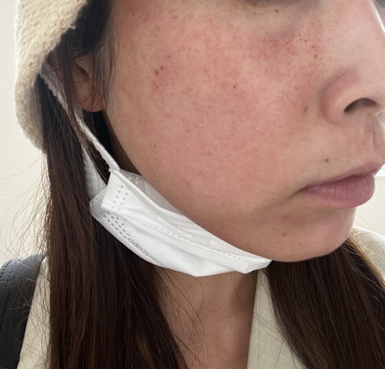 after photo: ピコトーニング, ピコフラクショナル