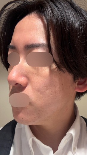 after photo: ポテンツァ(POTENZA)