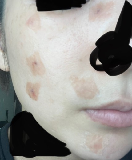 after photo: CO2レーザー, ほくろ除去(レーザー), QスイッチYAGレーザー(CuRAS Hybrid)