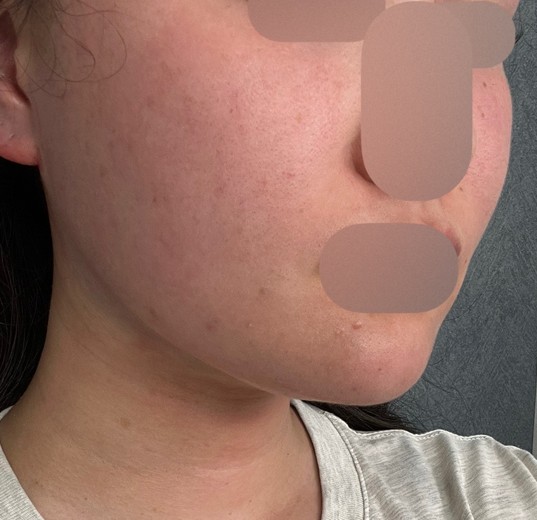 after photo: 脂肪吸引注射