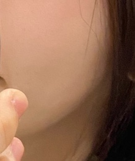 after photo: 튠페이스리프팅, 티타늄리프팅