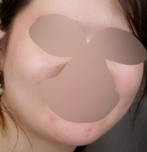 before photo: 脂肪溶解注射(顔)