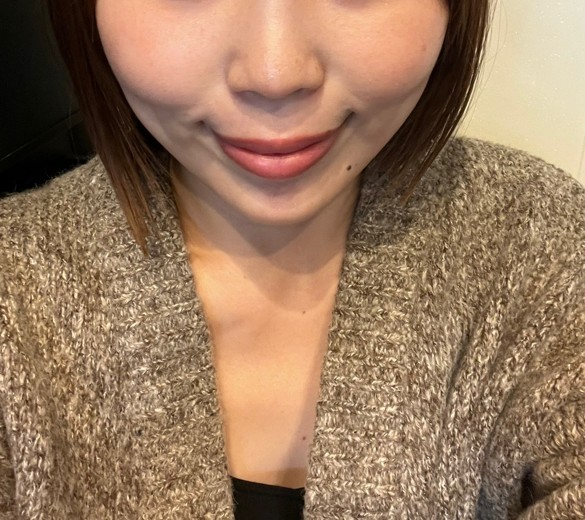 before photo: 脂肪溶解注射(顔)