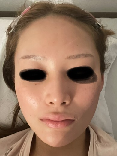 before photo: ジュベルック(Juvelook), サブシジョン(ニキビ跡治療)