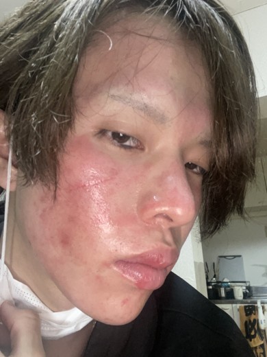 after photo: ダーマペン